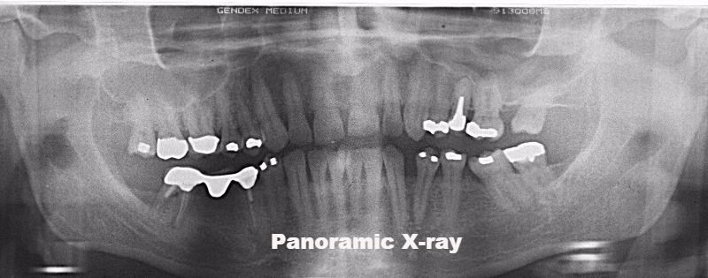 Panoramic X-ray, Alpha Dental Care St Louis MO
